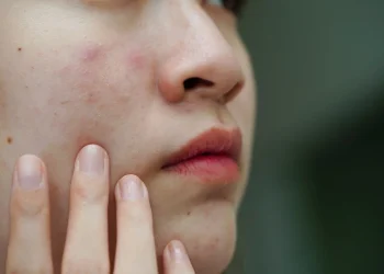 Skin Barrier Rusak? Ini Cara Memperbaikinya